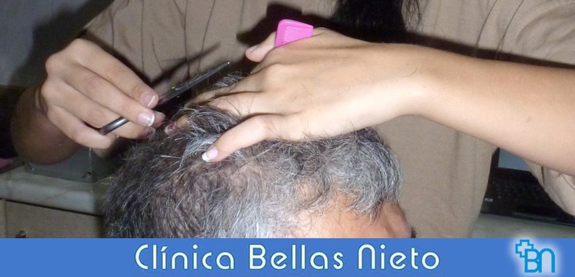 Tiña en Peluquerías